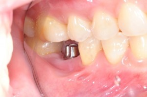 implant1