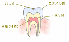虫歯の進行：C0