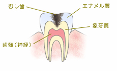 虫歯の進行：C2