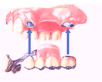 マグネットデンチャーイメージ